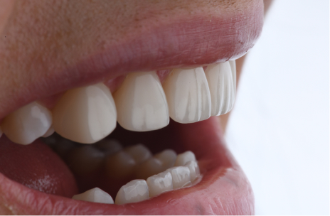 Composite bonding at Sherwood Dental Practice