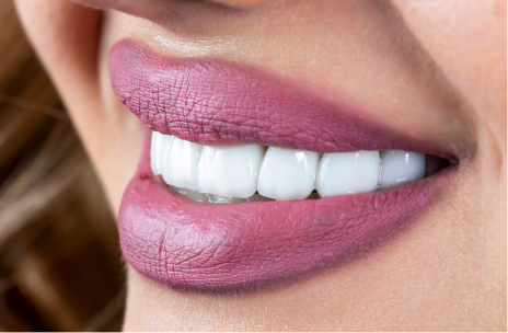 Porcelain veneers at Sherwood Dental Practice